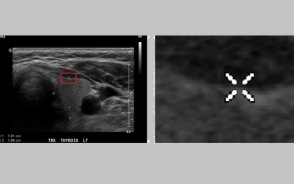 Thyroid Nodule Classification in Ultrasound Images